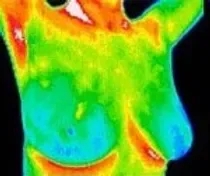 What is Infrared Breast Thermography?