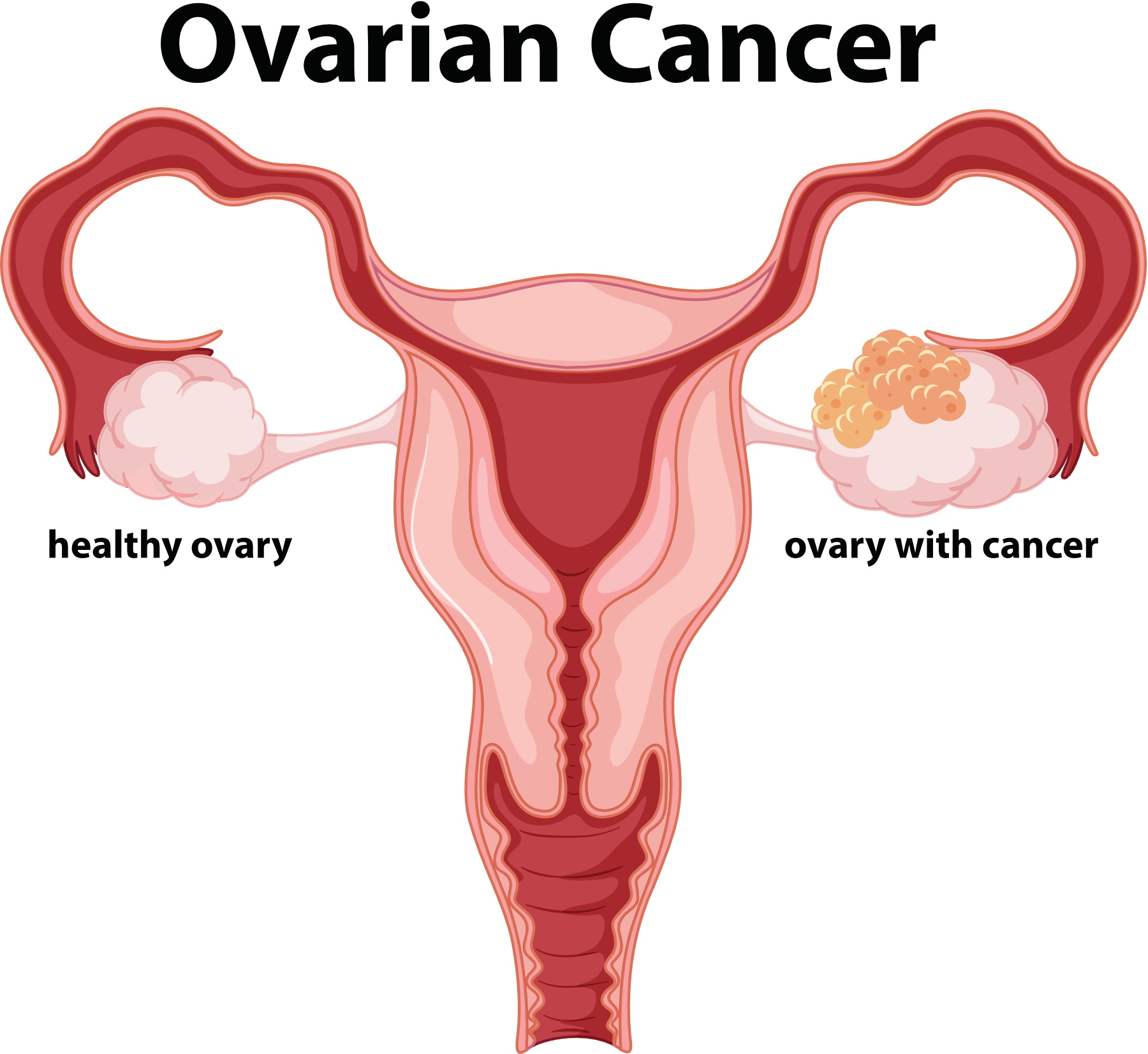 Ovarian Cancer Treatment Choices by Type and Stage