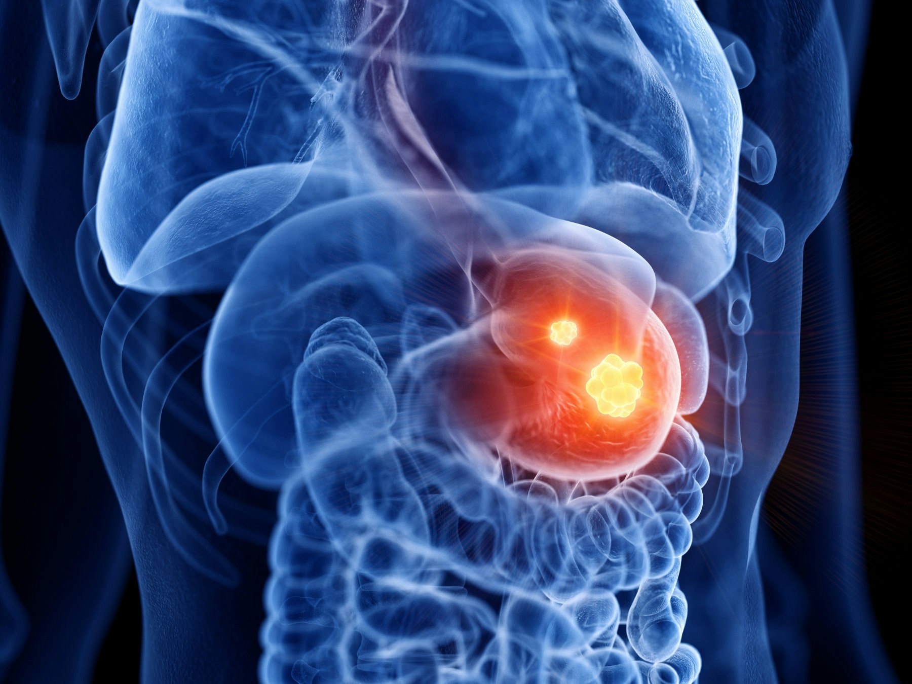 Stomach Cancer Treatment Choices by Type and Stage