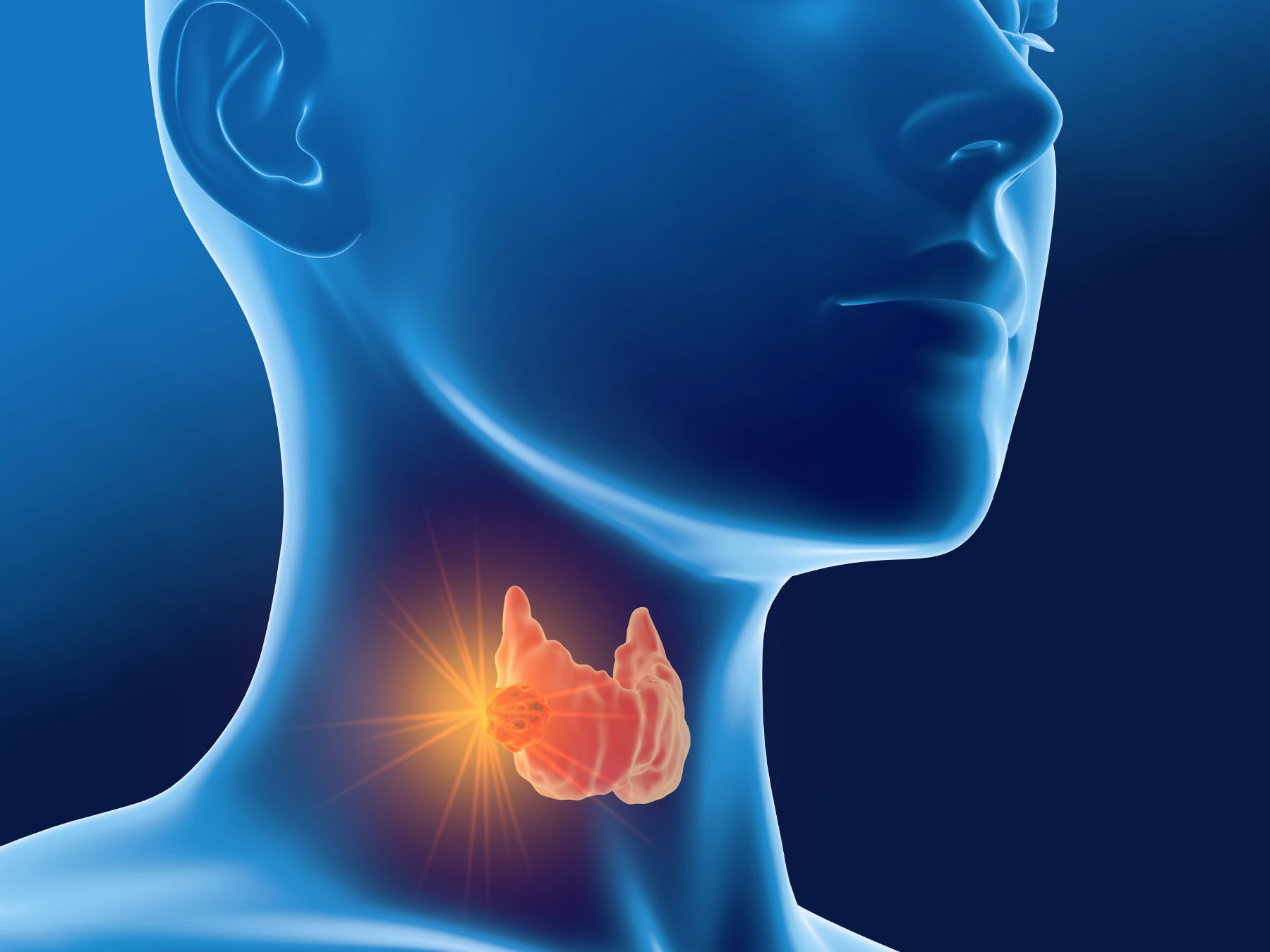 Thyroid Cancer Treatment Choices by Type and Stage