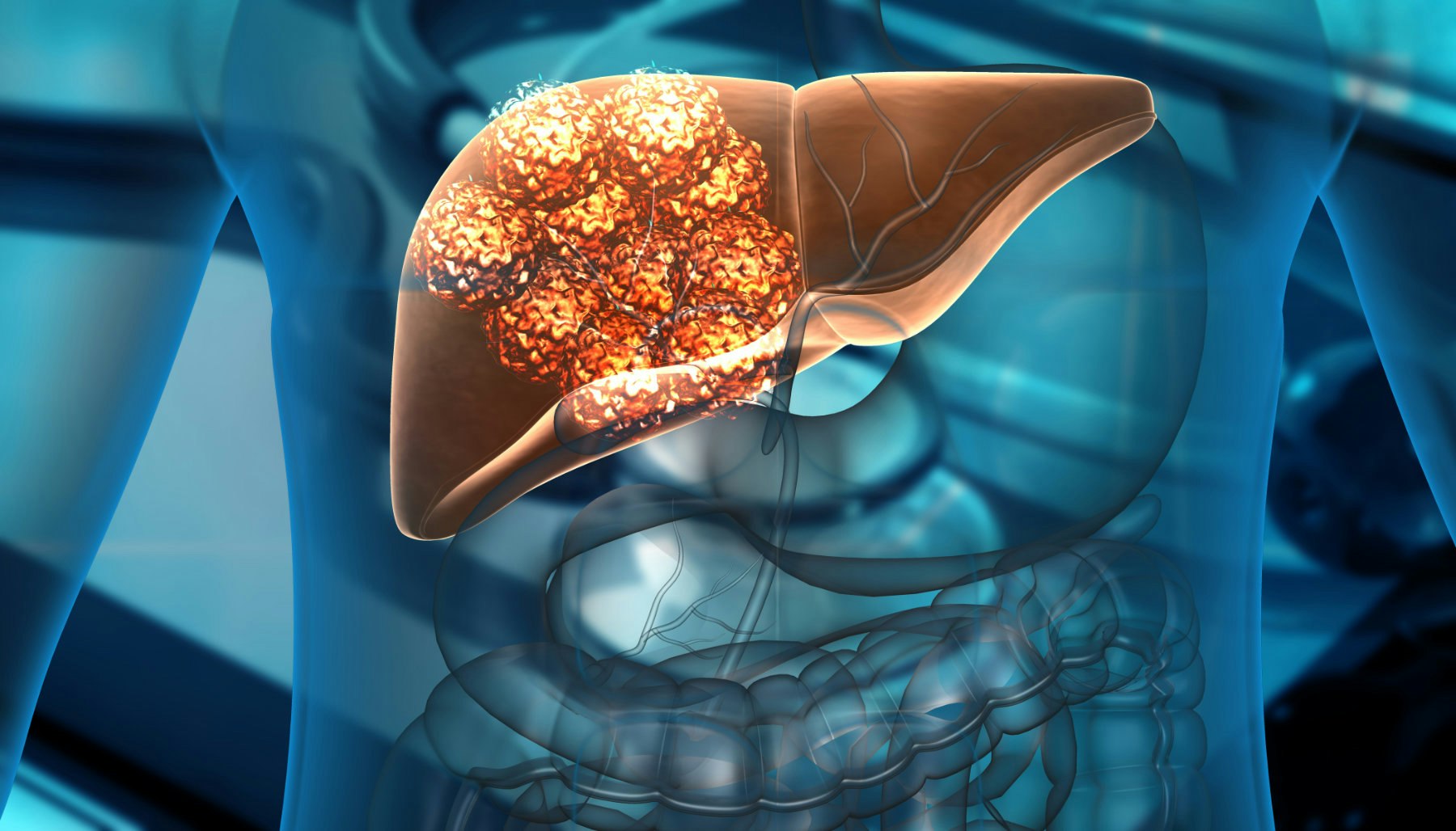 Liver Cancer Treatment Choices by Type and Stage