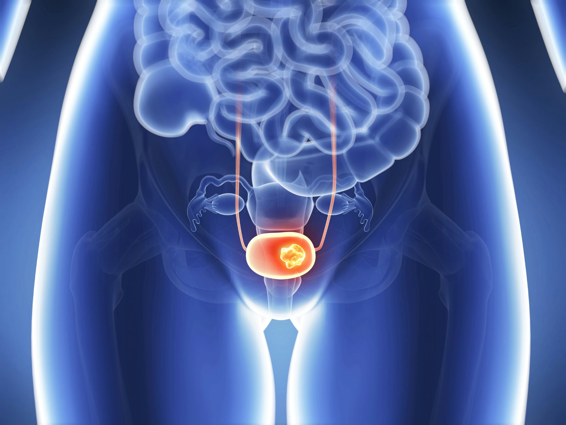 Bladder Cancer Treatment Choices by Type and Stage