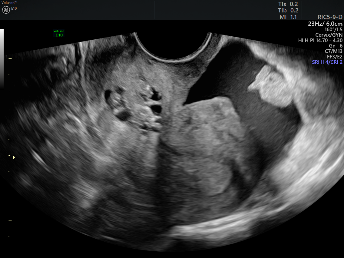 Diagnosing the Cause of and Measuring Cul de Sac Fluid Empowered