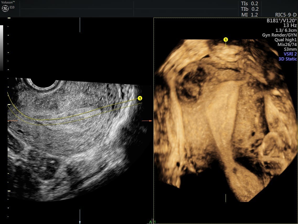 How Monitoring Uterine Fibroids Can Preserve Fertility | Empowered