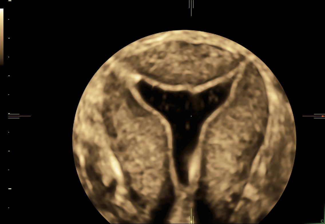 tubal-patency-ultrasound-empowered-women-s-health