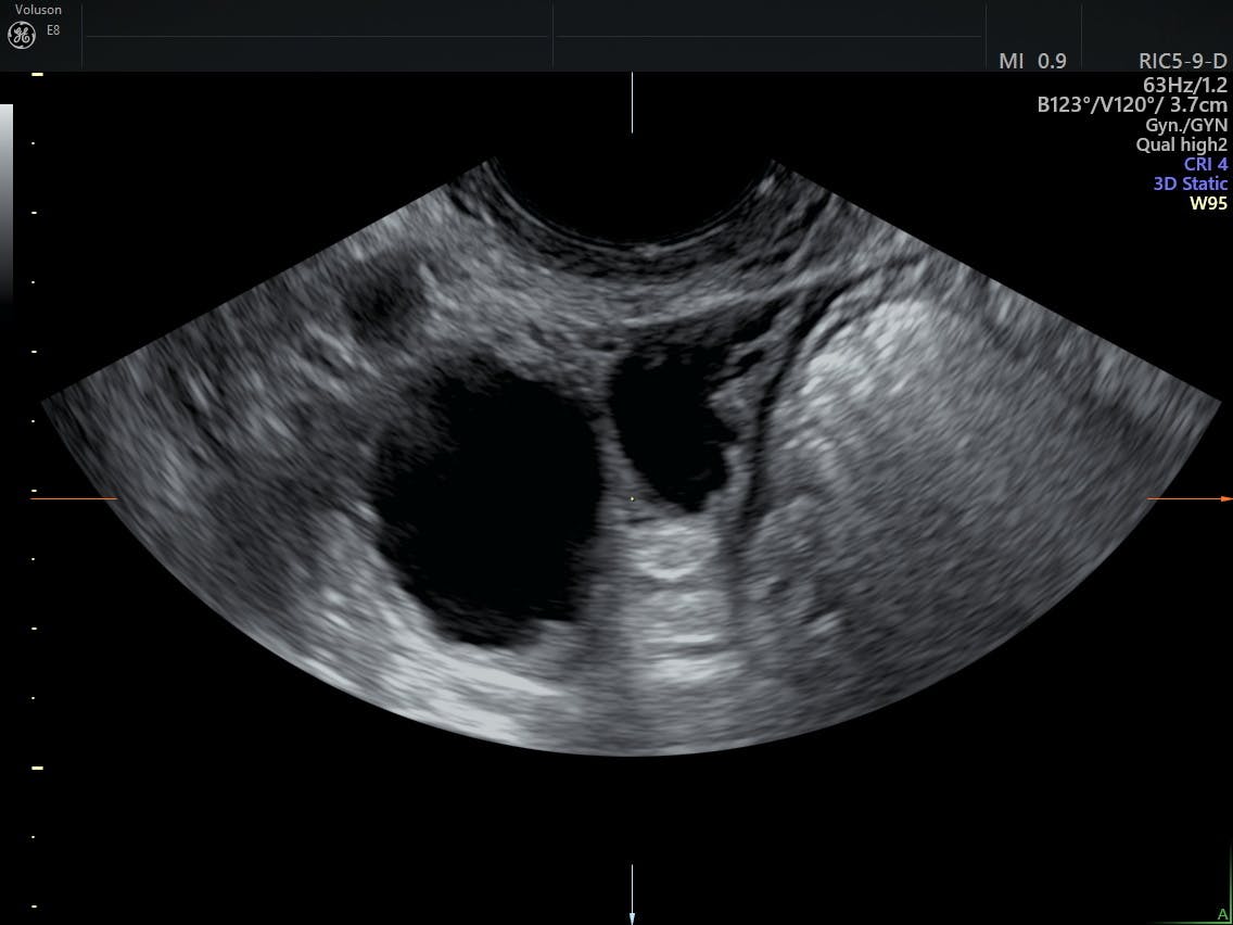 Using Ultrasound To Monitor Tubo-Ovarian Abscess and PID | Empowered ...