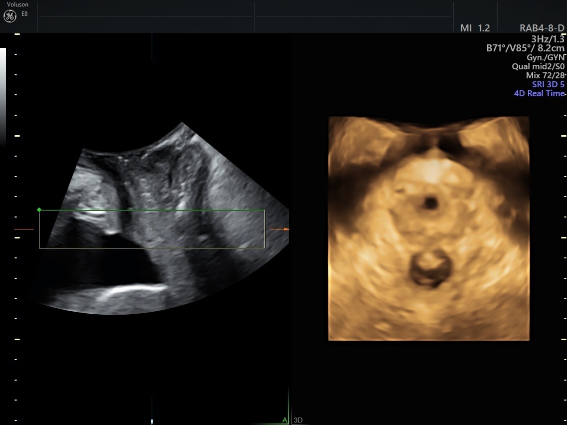 Female Urethral Diverticulum: Diagnosis, Treatment and Outcome