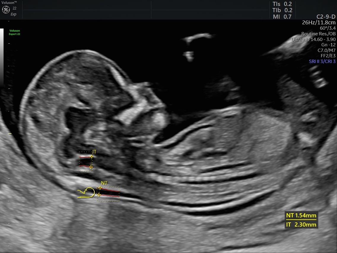 nuchal-translucency-a-critical-ultrasound-test-in-pregnancy