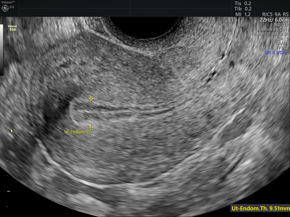 Endometrial Hyperplasia Classification Empowered Womens Health