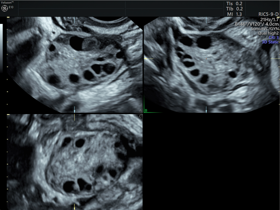 Pcos Diagnosis And The Role Of Pelvic Ultrasound Empowered Womens Health 