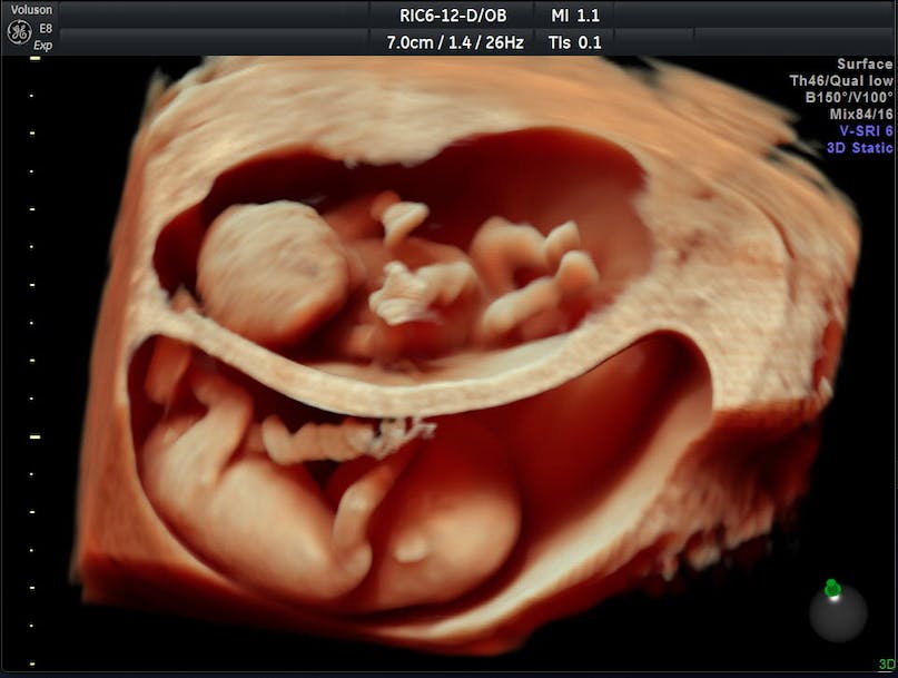 Twin pregnancy ultrasound images