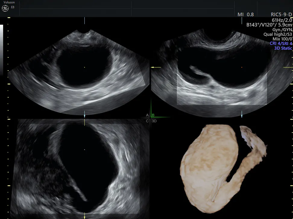 How To Use 3d Ultrasound In Hydrosalpinx Treatment Empowered