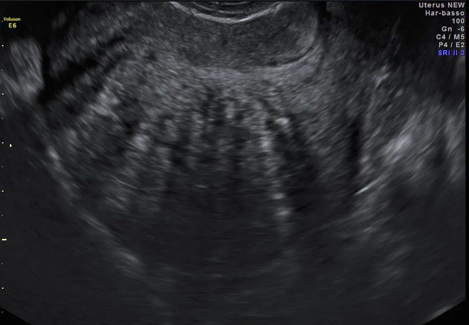 Why Adenomyosis Ultrasound Could Replace Mri In Diagnosis Empowered Women S Health