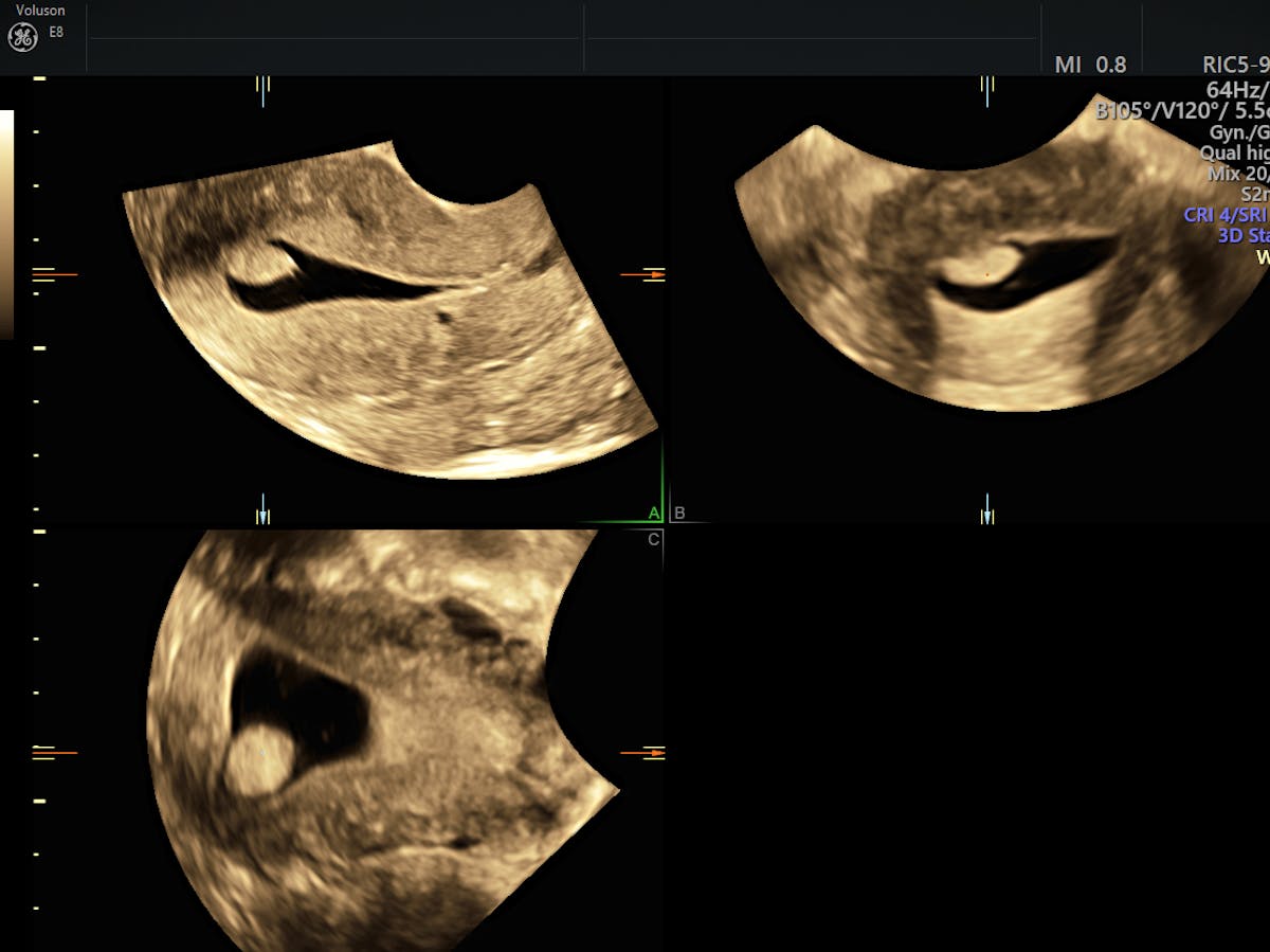 Endometrial Polyp Ultrasound & SIS: The Gold Standard | Empowered Women ...