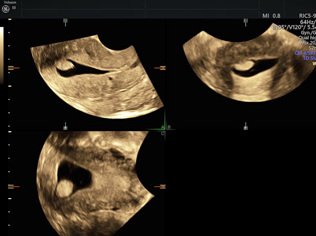 Endometrial Polyp Ultrasound And Sis The Gold Standard Empowered Womens Health 