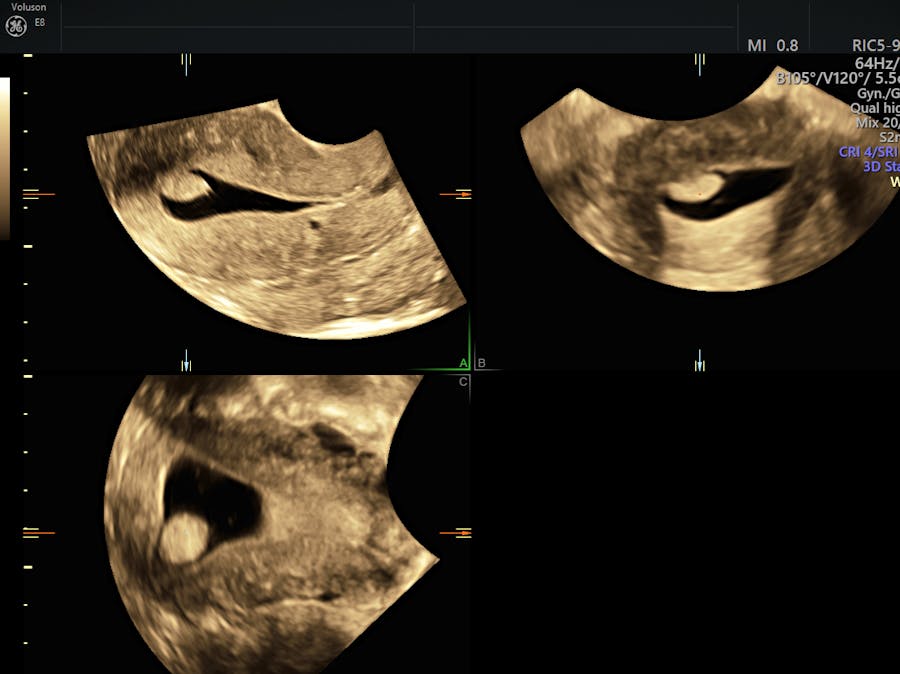 Endometrial Polyp Ultrasound And Sis The Gold Standard Empowered Womens Health 