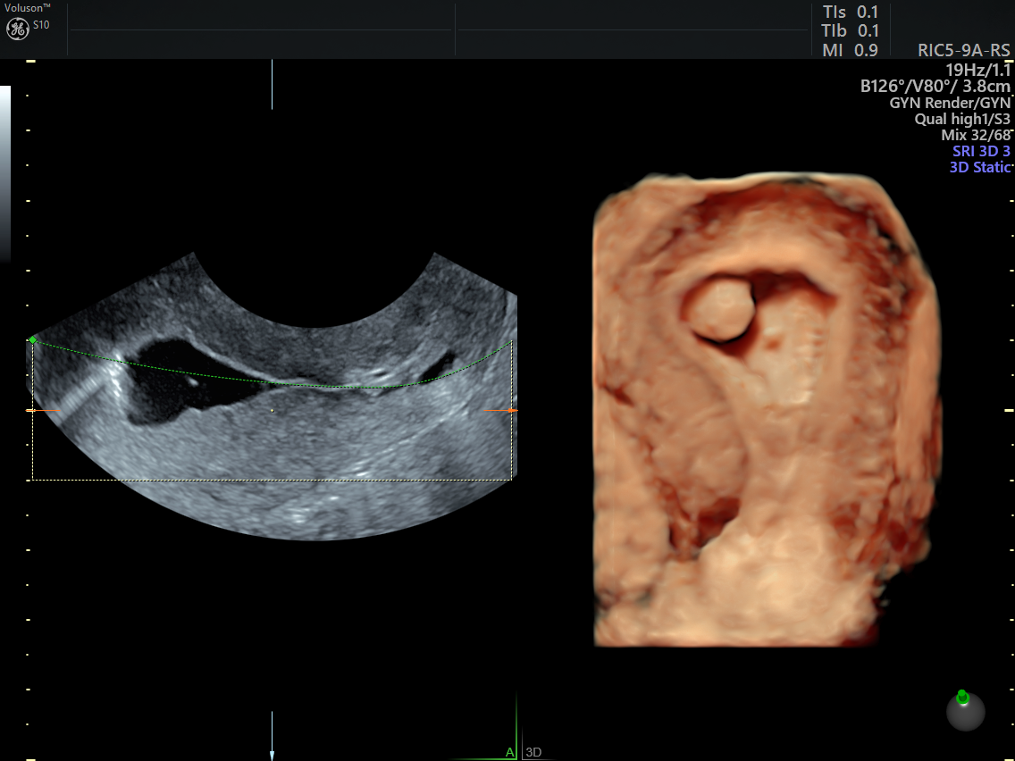 What Are Menstrual Migraines and How Can They Be Managed? - The Ultrasound  SuiteThe Ultrasound Suite