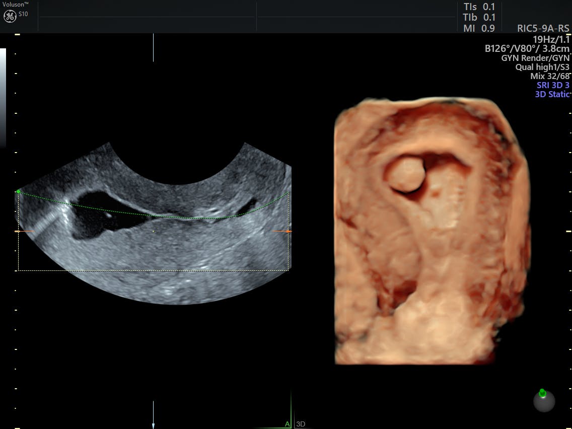 Common Perimenopause Symptoms Ultrasound Diagnosis Empowered Women S Health