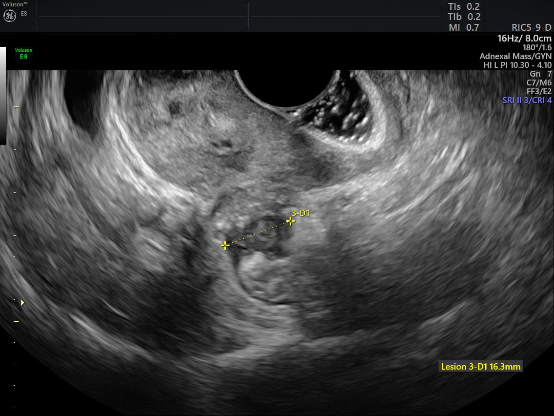 The Role of Endometriosis Specialists & Doctors in Treatment