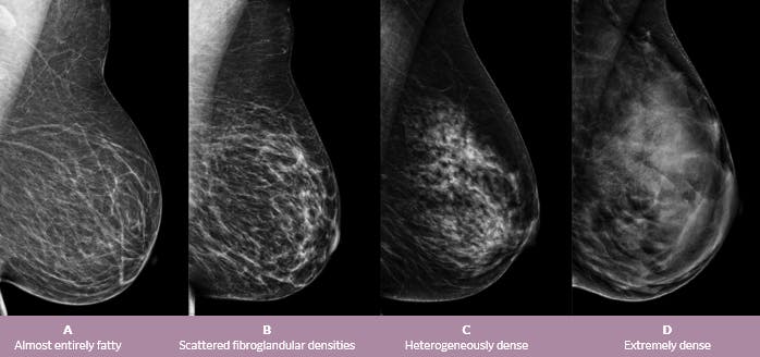 How To Use 3d Breast Ultrasound For Dense Breast Tissue Empowered Women S Health