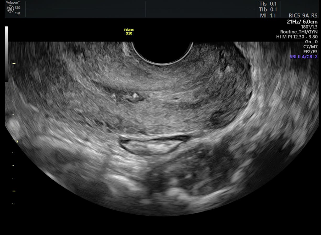 Cervical Lesions Ultrasound