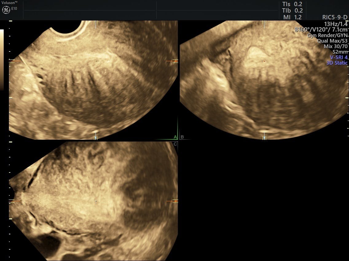 Adenomyosis And Pregnancy Understanding Miscarriage Risk Empowered Women S Health