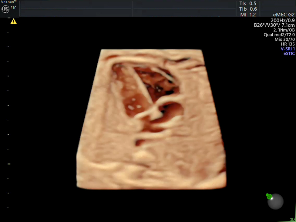 Fetal Heart Defects Ultrasound Empowered Women S Health