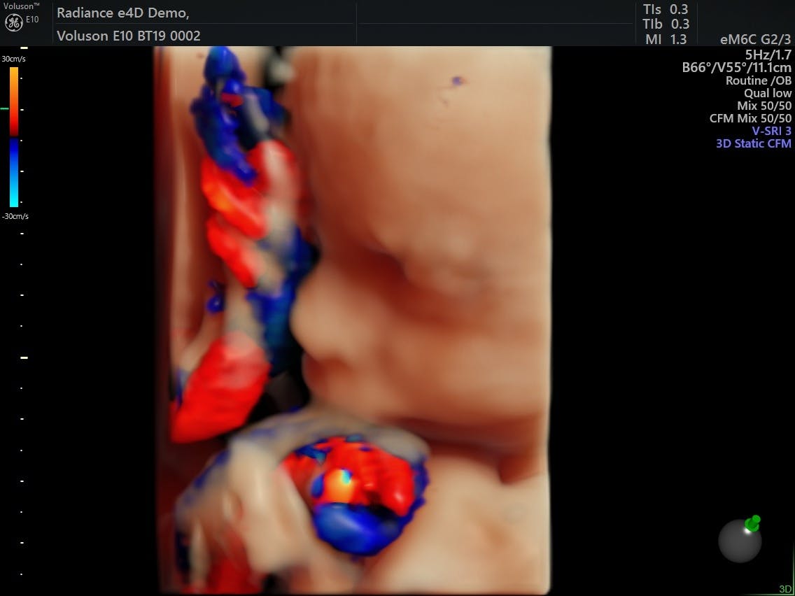 Doppler sonography