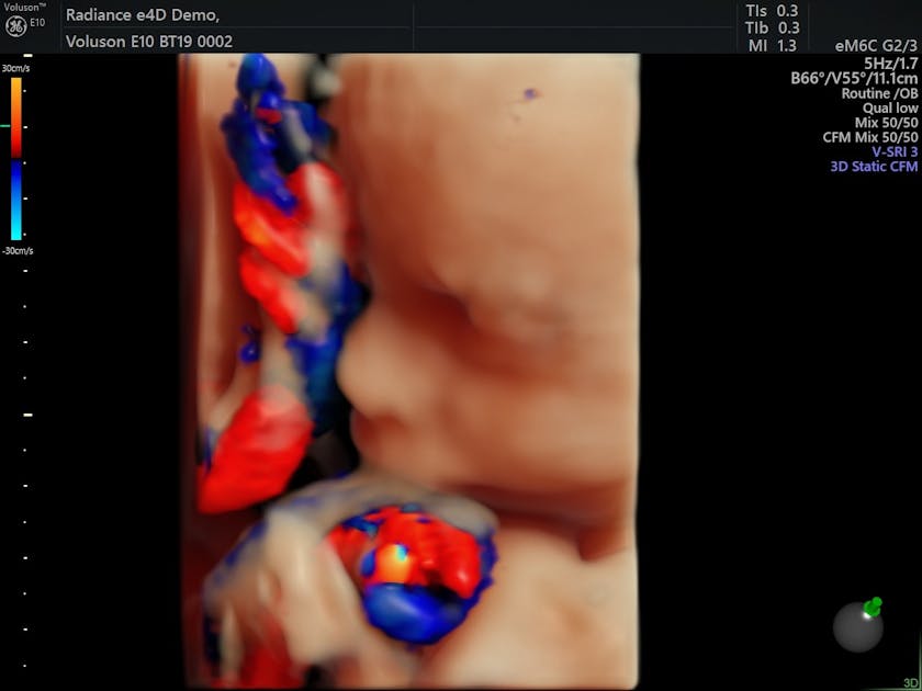 Umbilical Artery Doppler Assessment: A How-To Guide | Empowered 