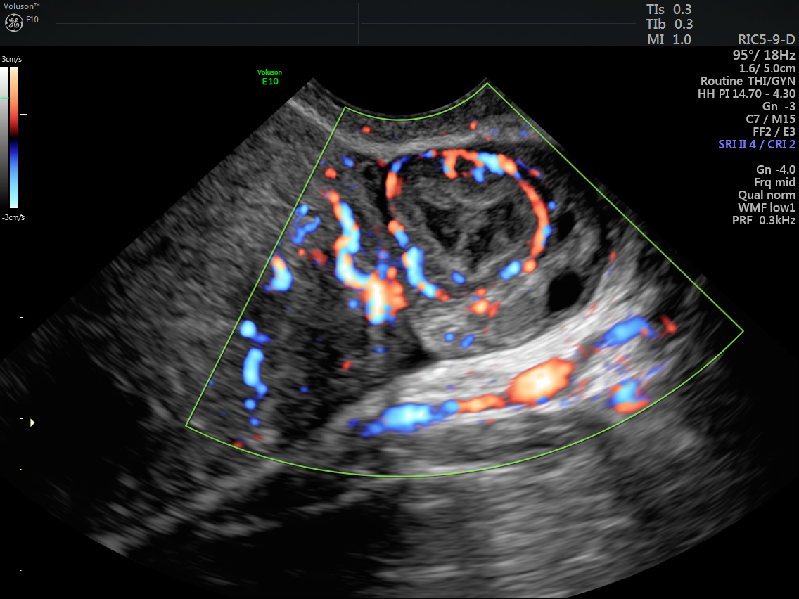 Non-contrast power Doppler ultrasound imaging for early assessment