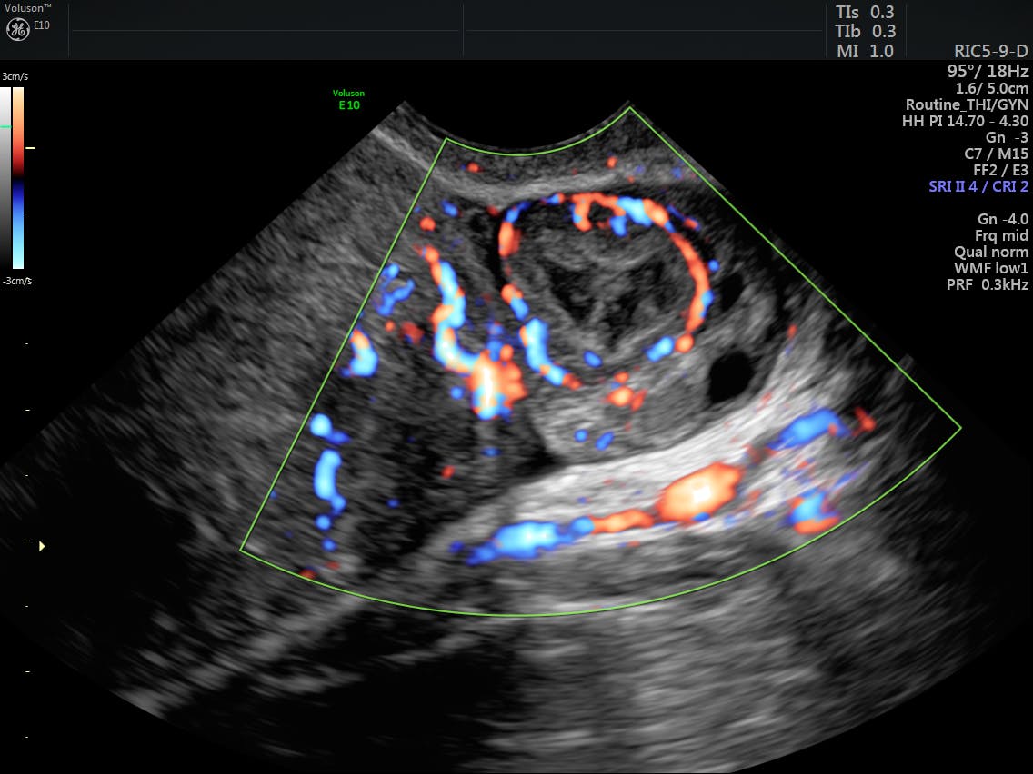 Power Doppler And 3d Ultrasound To Diagnose Ovarian Lesions Empowered