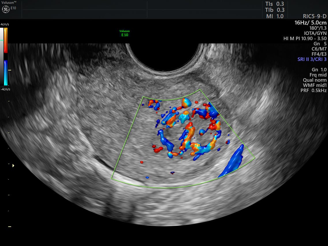 Ultrasound Fibroids | Empowered Women's Health