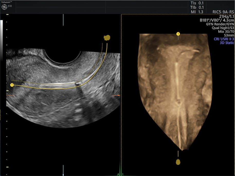 The Effectiveness of Using Ultrasound for IUD Removal | Empowered Women ...