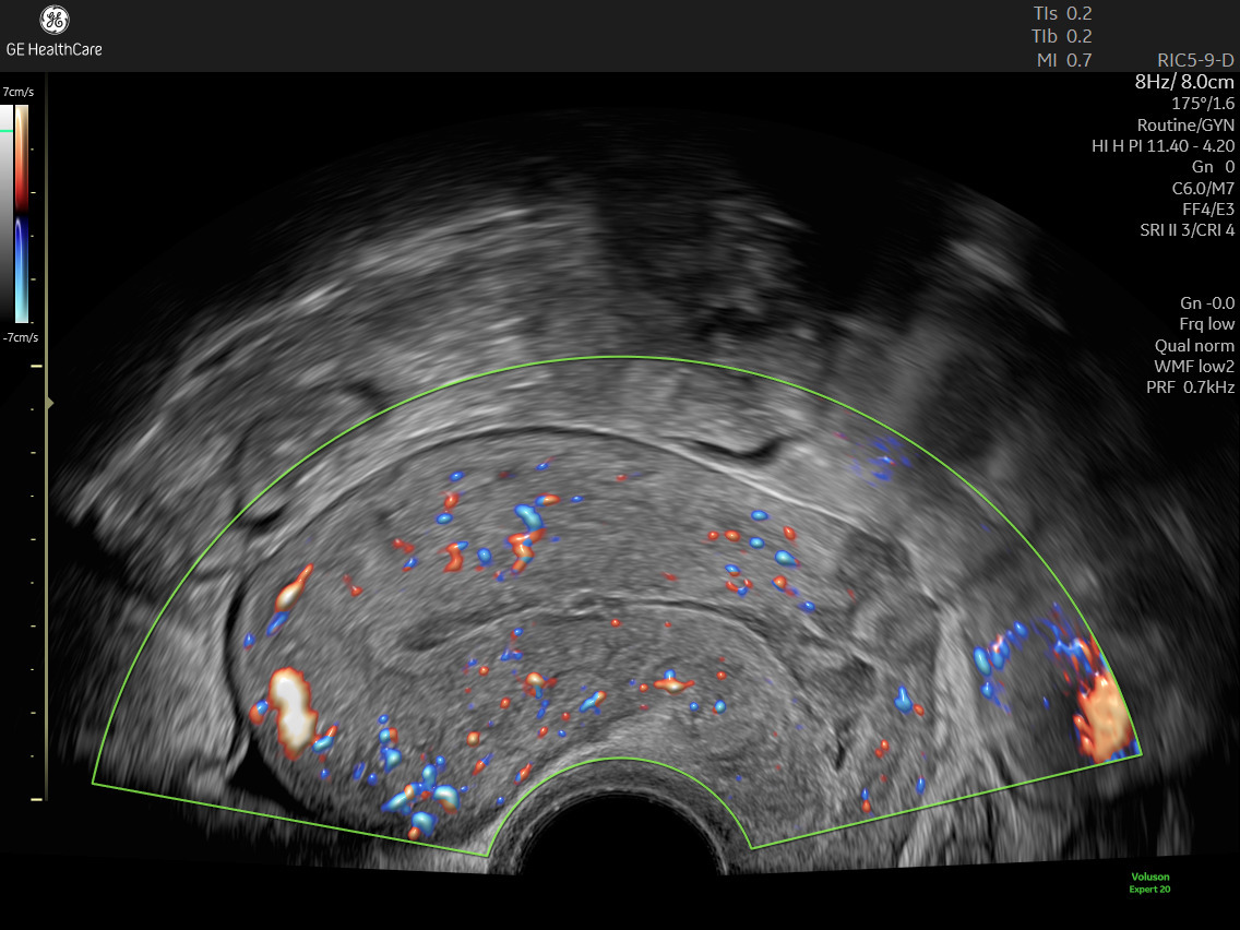 Endometrial Thickness - Importance, Changes and Treatments