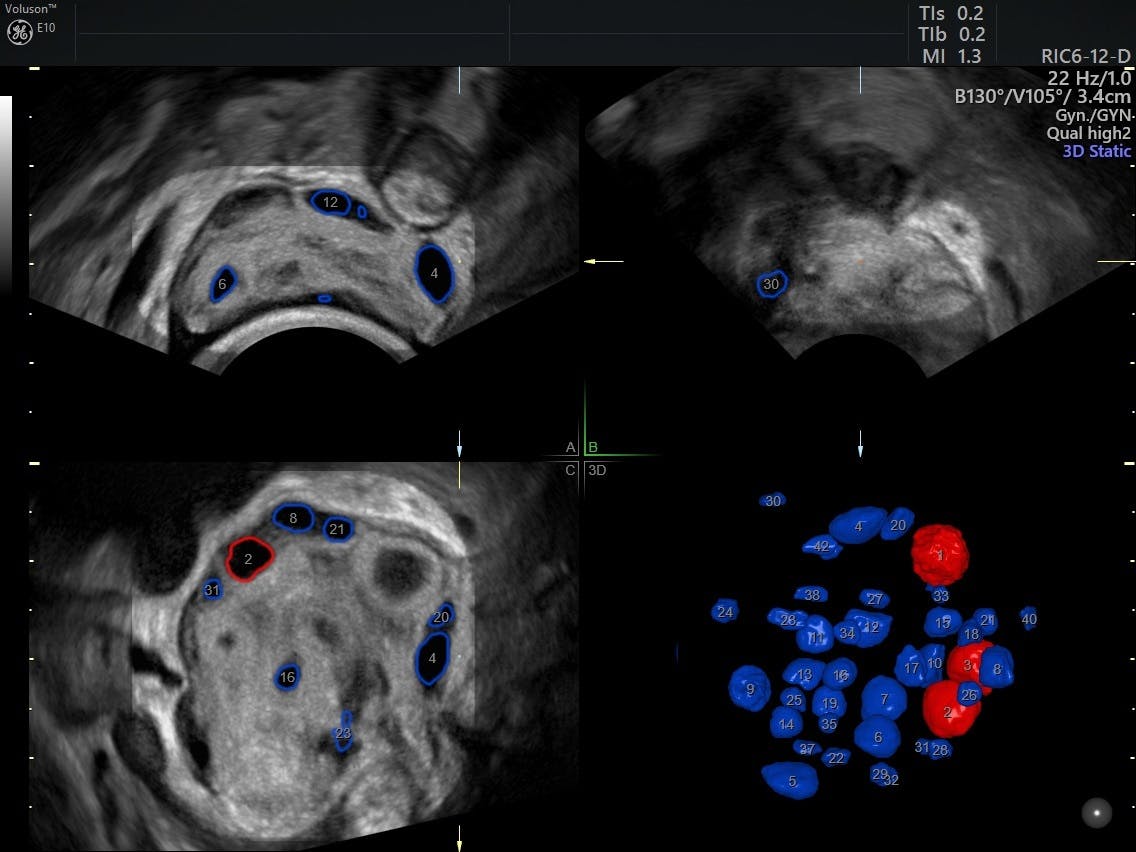 diagnosing-premature-ovarian-failure-with-ultrasound-empowered-women