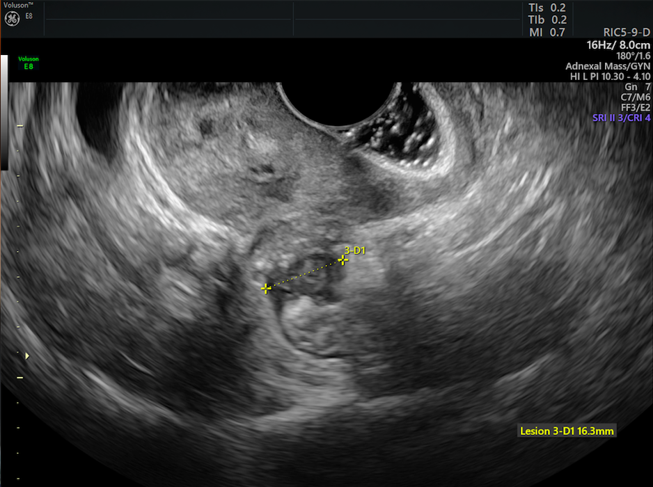 Diagnosing Endometriosis By Comparing Ultrasound And Mri Empowered Womens Health 9103