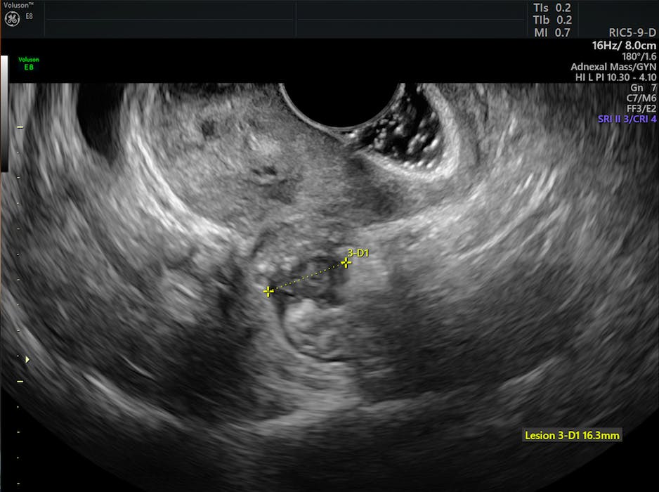 Diagnosing Endometriosis by Comparing Ultrasound & MRI ...