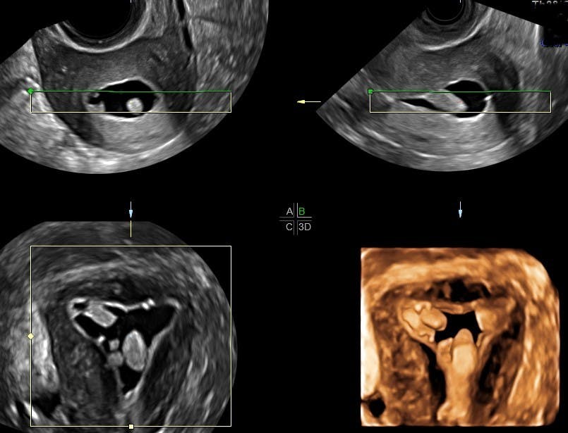 Saltvand Infusion Sonogram Diskutere Sis Ultralyd Precision 