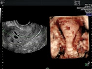 Detecting Endometrial Carcinoma With Ultrasound Empowered Women s Health