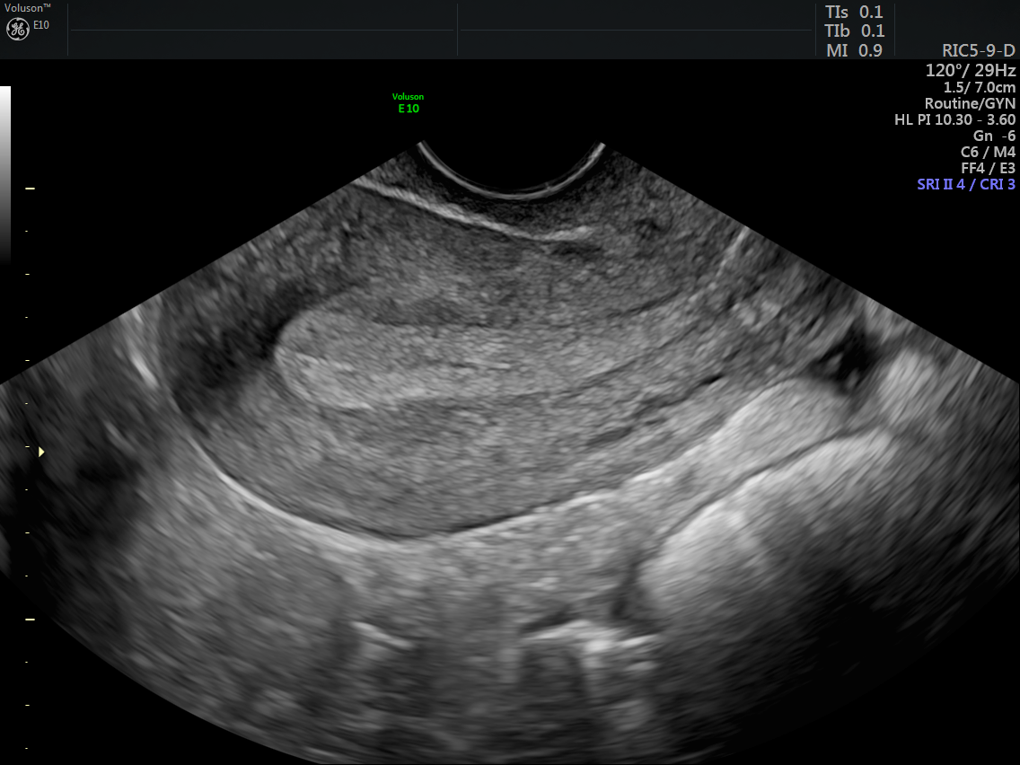 Transvaginal Ultrasound Showing A Thick Endometrial C