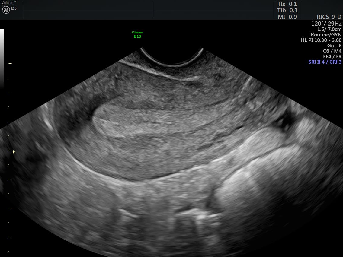 Эндометрия 16 мм. Эндометриоз матки снимки УЗИ.