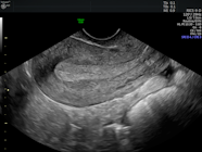 Ultrasound Characteristics Of Endometrial Cancer As Defined 41 OFF