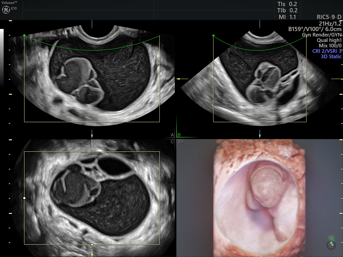 Ovarian Cysts