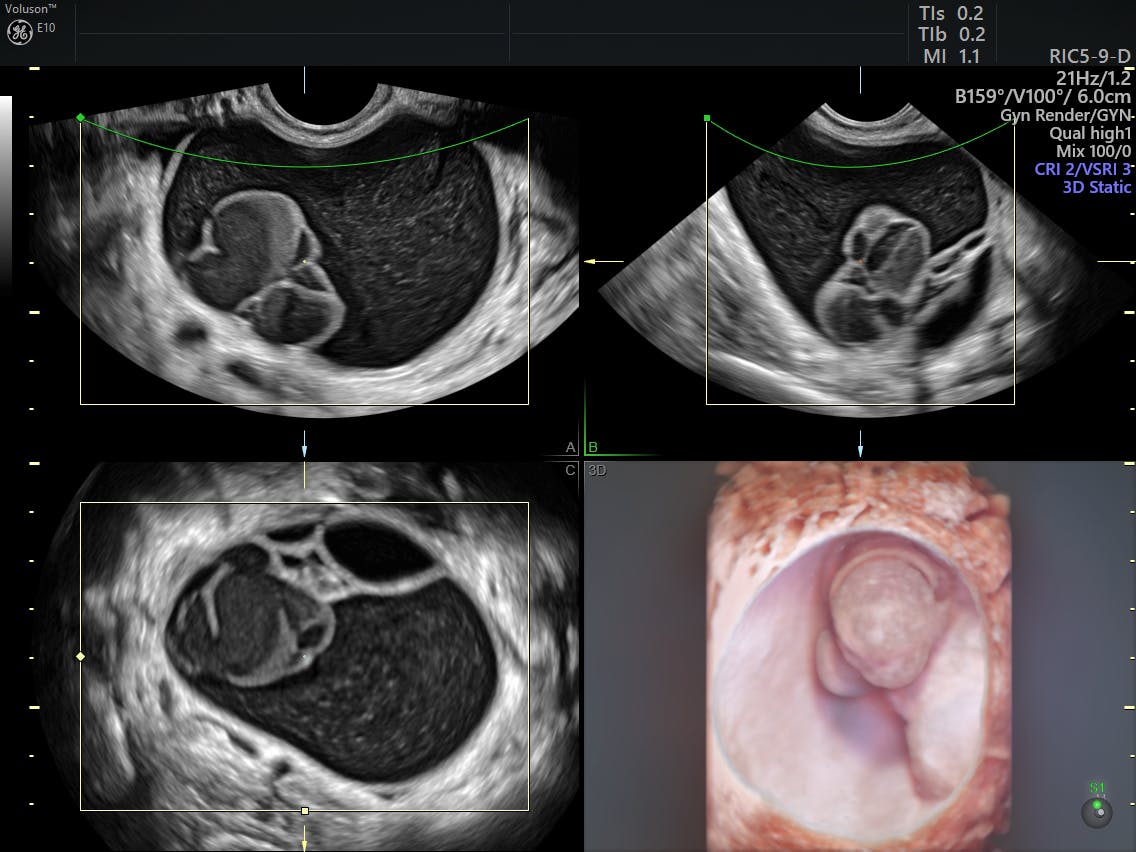 Simple Vs Complex Ovarian Cysts The Link To Ovarian Cancer