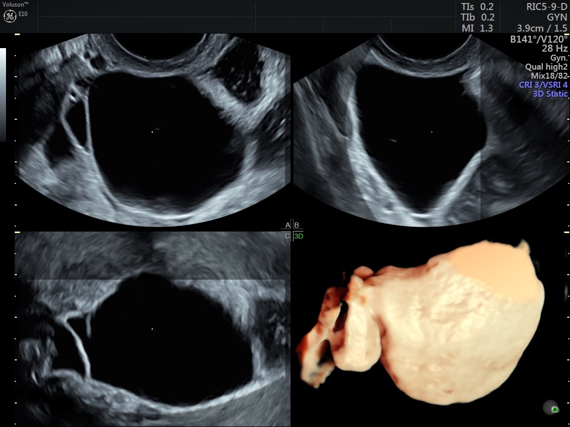 Tubal Ligation vs. Salpingectomy Which Is Best? Empowered Women's Health