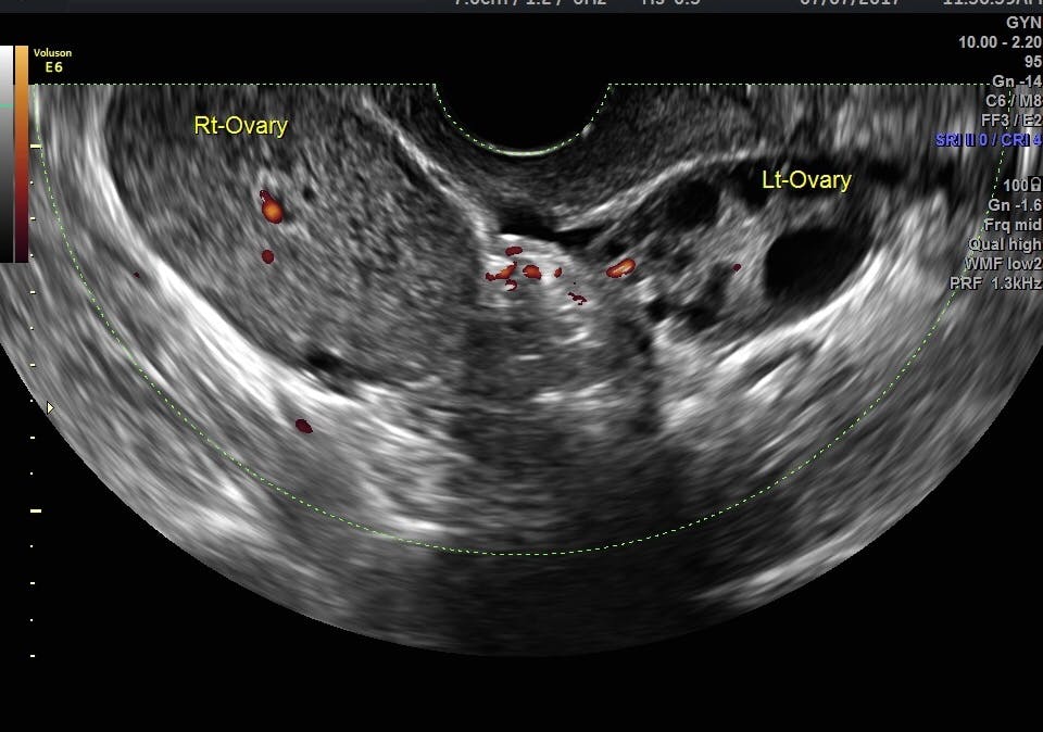 Diagnosing Ovarian Torsion With Ultrasound Empowered Women S Health