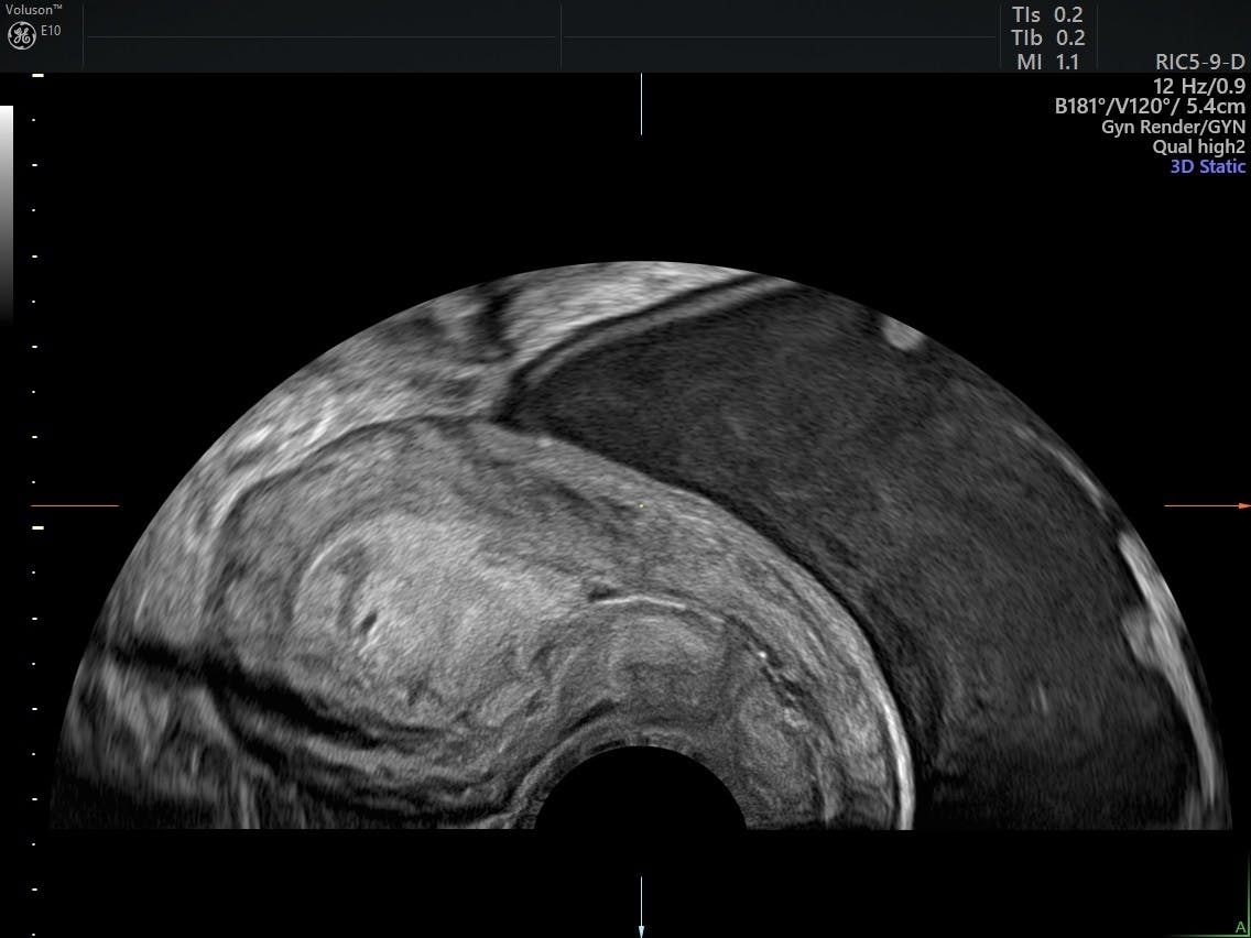 The Assessment Diagnosis And Causes Of Endometrial Cancer Empowered Women S Health