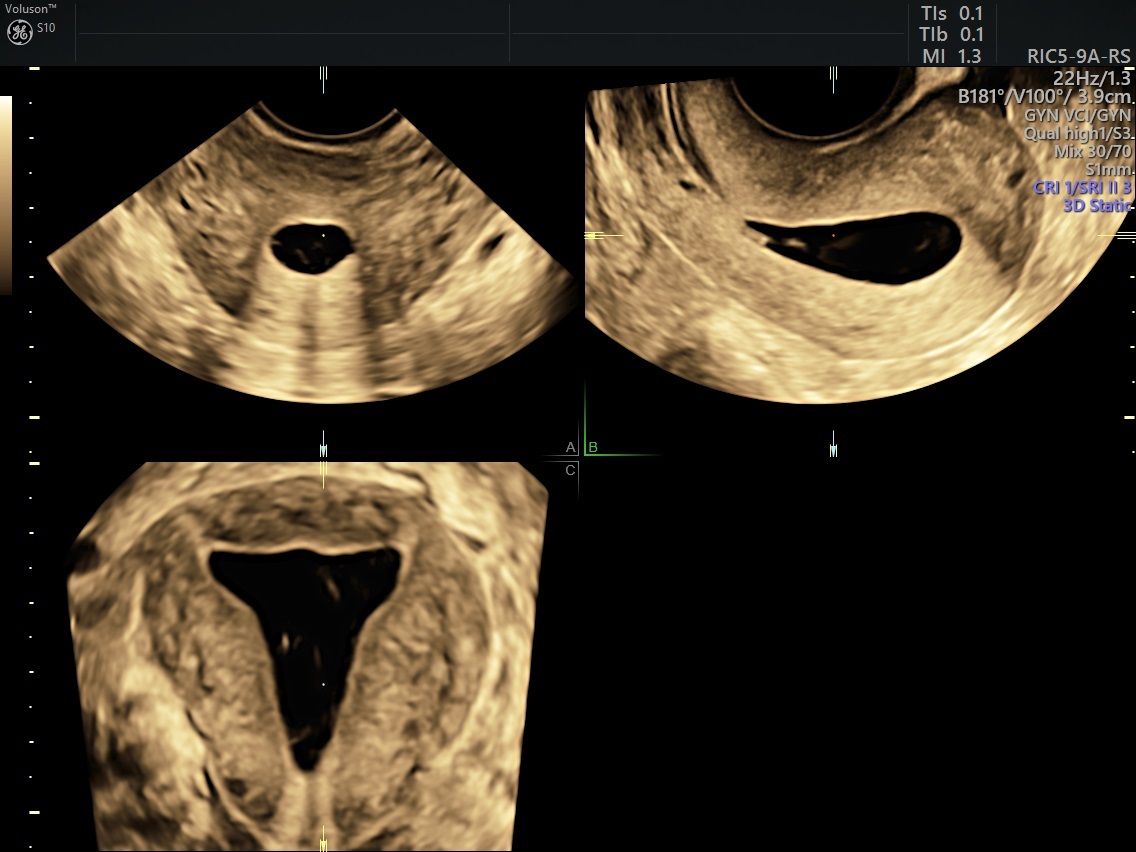 Using GIS or SIS for Menorrhagia Ultrasound | Empowered ...