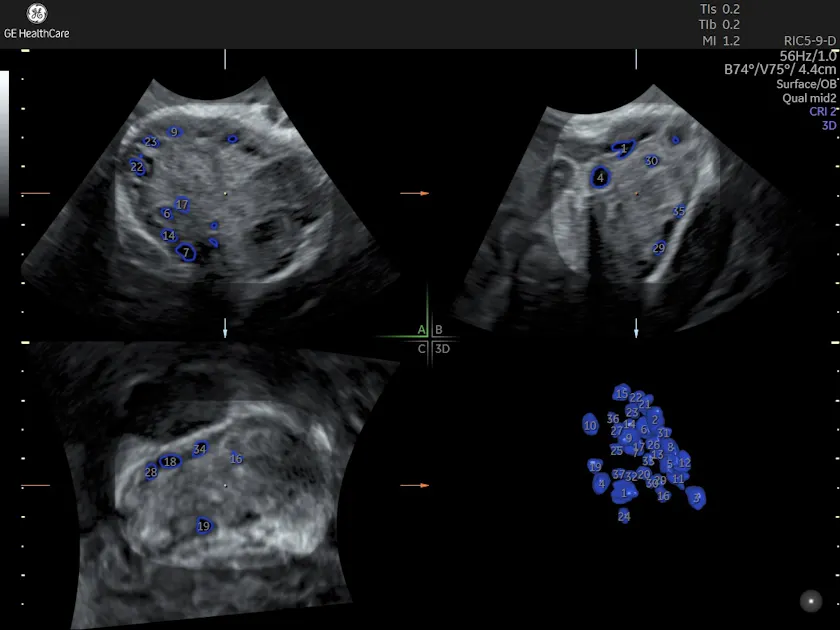Antral Follicle Count Ultrasound | The Role of 3D Imaging | Empowered ...