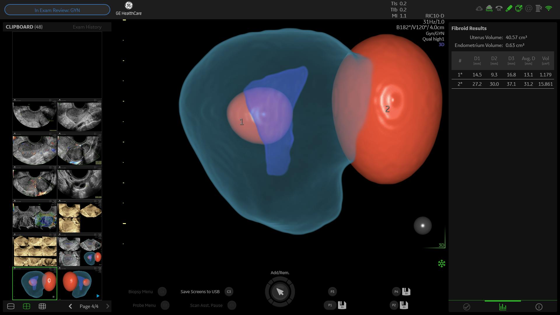 Ultrasound Fibroids Diagnostic Advancement with Fibroid Mapping 